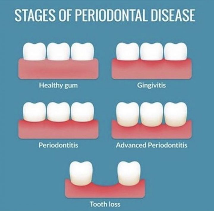 What causes tooth loss? Cures 'n' Care Dental Clinic Blog