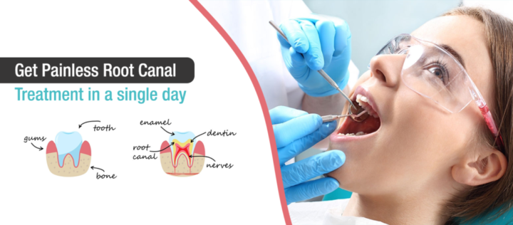 painless root canal treatment mayur vihar-2